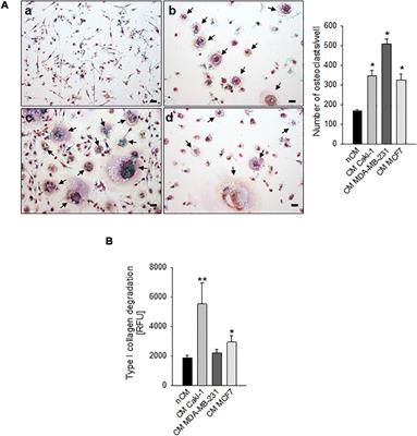 Acid-Induced Inflammatory Cytokines in Osteoblasts: A Guided Path to Osteolysis in Bone Metastasis